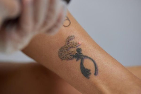 laserowe usuwanie tatuażu poznań